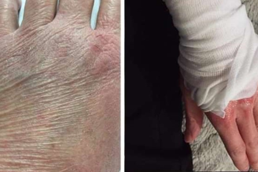 Les soignants montrent ce qu’ils vivent : épuisés et avec les mains ravagées par le gel hydroalcoolique